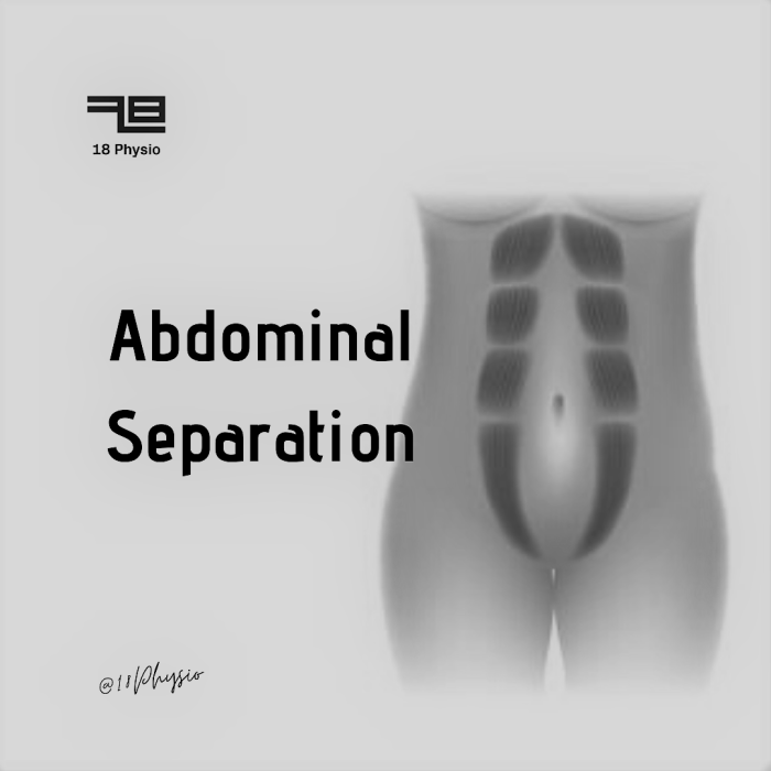 Why See a Physio If You Have an Abdominal Separation? - Sense Pelvic Physio